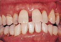 歯槽膿漏の歯肉